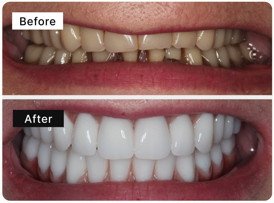 Composite bonding before and after