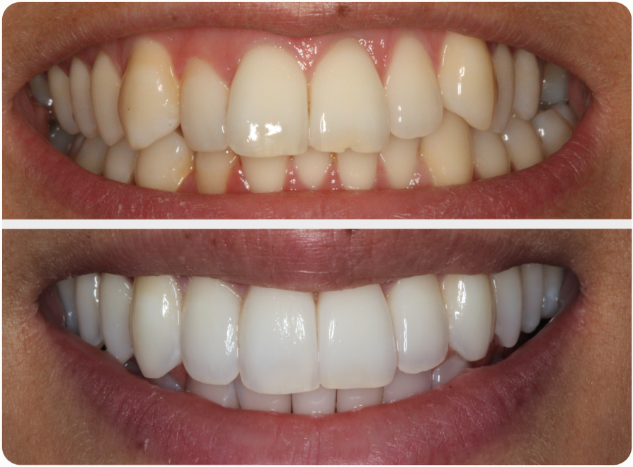 Before and after