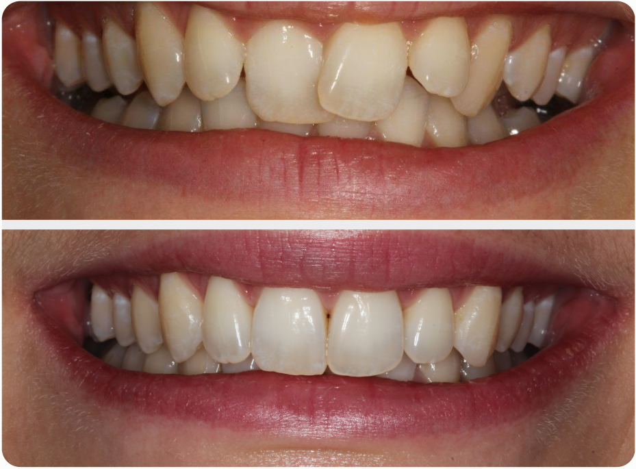 Before and after